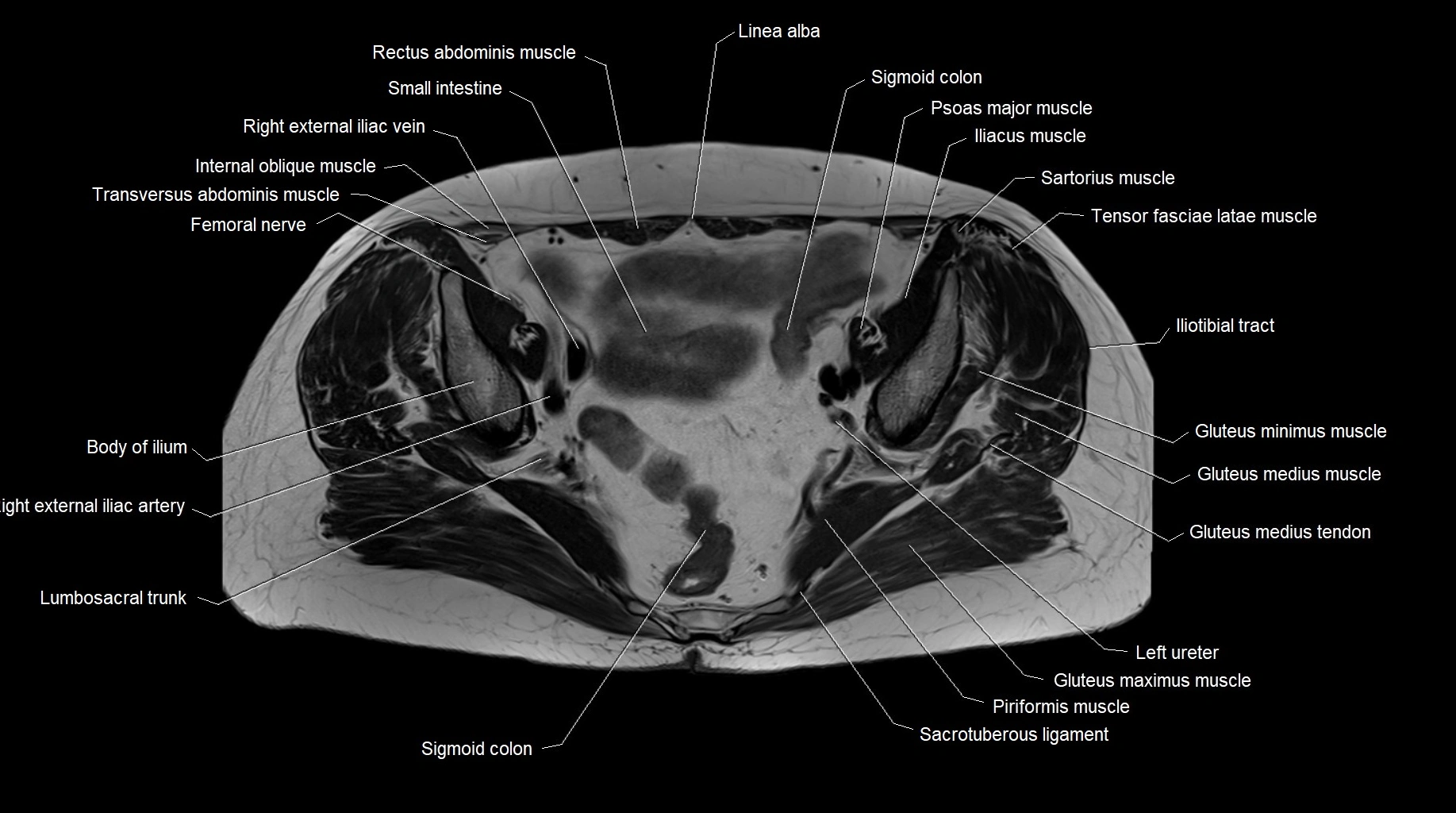 MRI 3T pelvis axial cross section anatomy image 16.webp